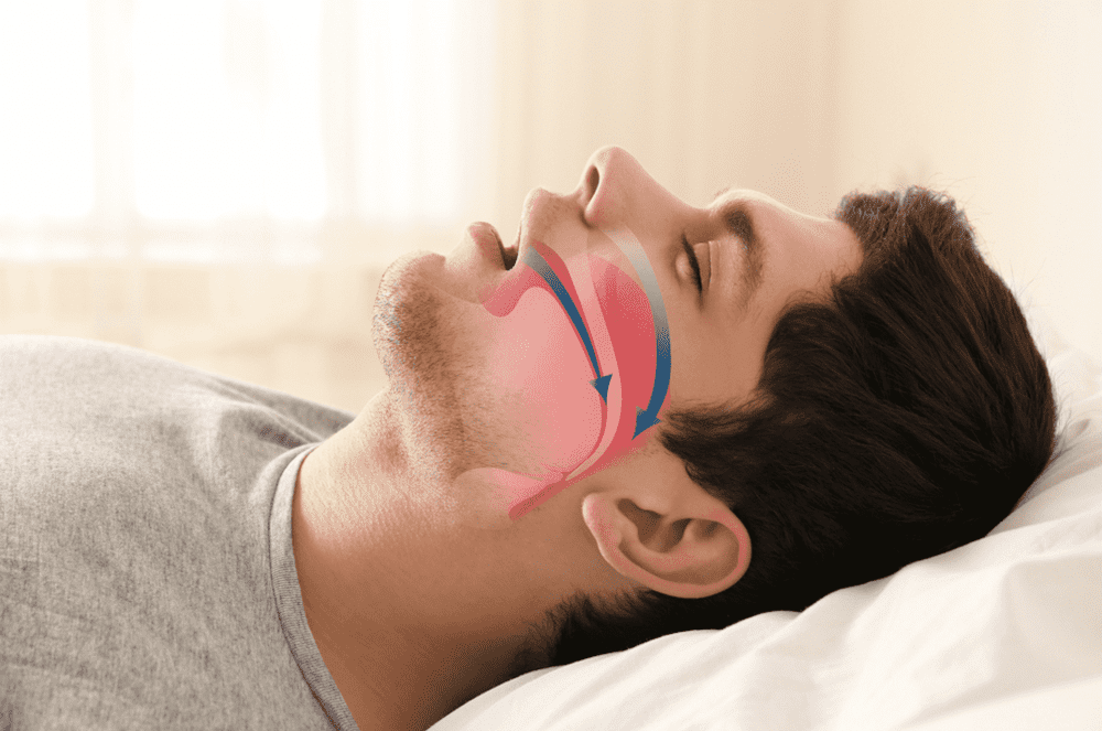 Sleep apnea symptoms